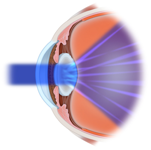 Diagram of the eye showing light passing through the lens